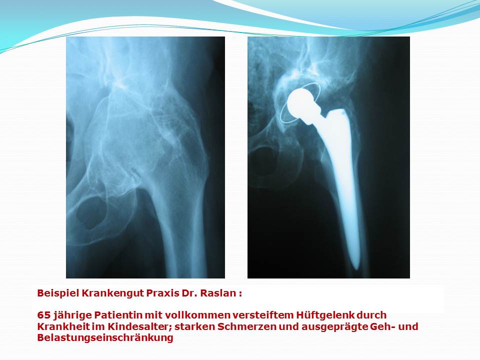 Künstlicher Hüftgelenkersatz